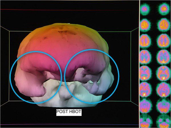 SPECT cerveau après oxygénothérapie hyperbare