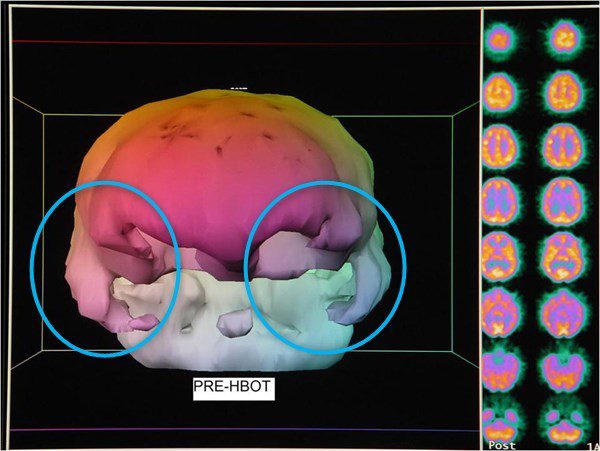 SPECT cerveau, avant oxygénothérapie hyperbare