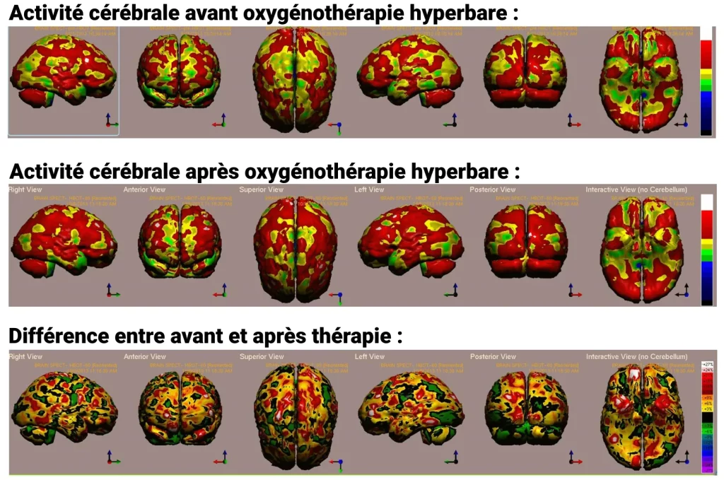 cerebro con oxigenoterapia hiperbárica